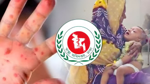 হাম ও উপসর্গে আরও ৯ শিশুর মৃত্যু