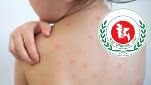 হাম ও উপসর্গে আরও ৯ শিশুর মৃত্যু